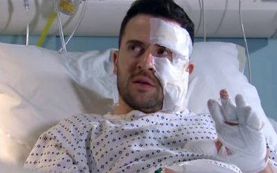 Burns advice for Emmerdale acid attack storyline